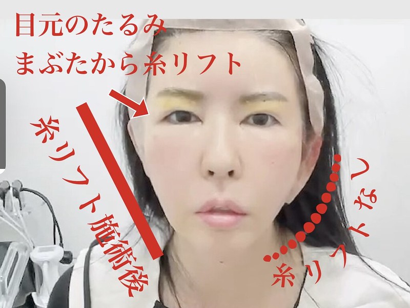 【韓国/ソウル】明洞駅すぐ！プチ整形・美肌管理に特化した「トックスエンフィル皮膚科」